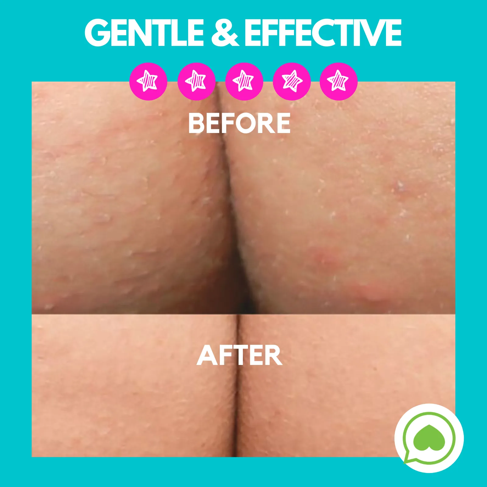 Butt Acne Clearing Lotion ® | 4 oz (113 gr)