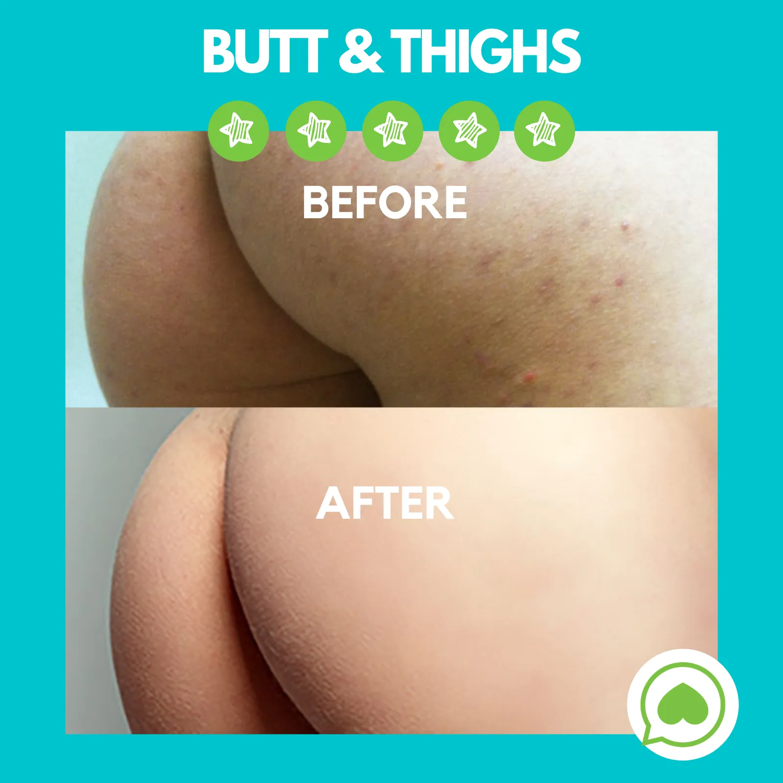 Butt Acne Clearing Lotion ® | 4 oz (113 gr)