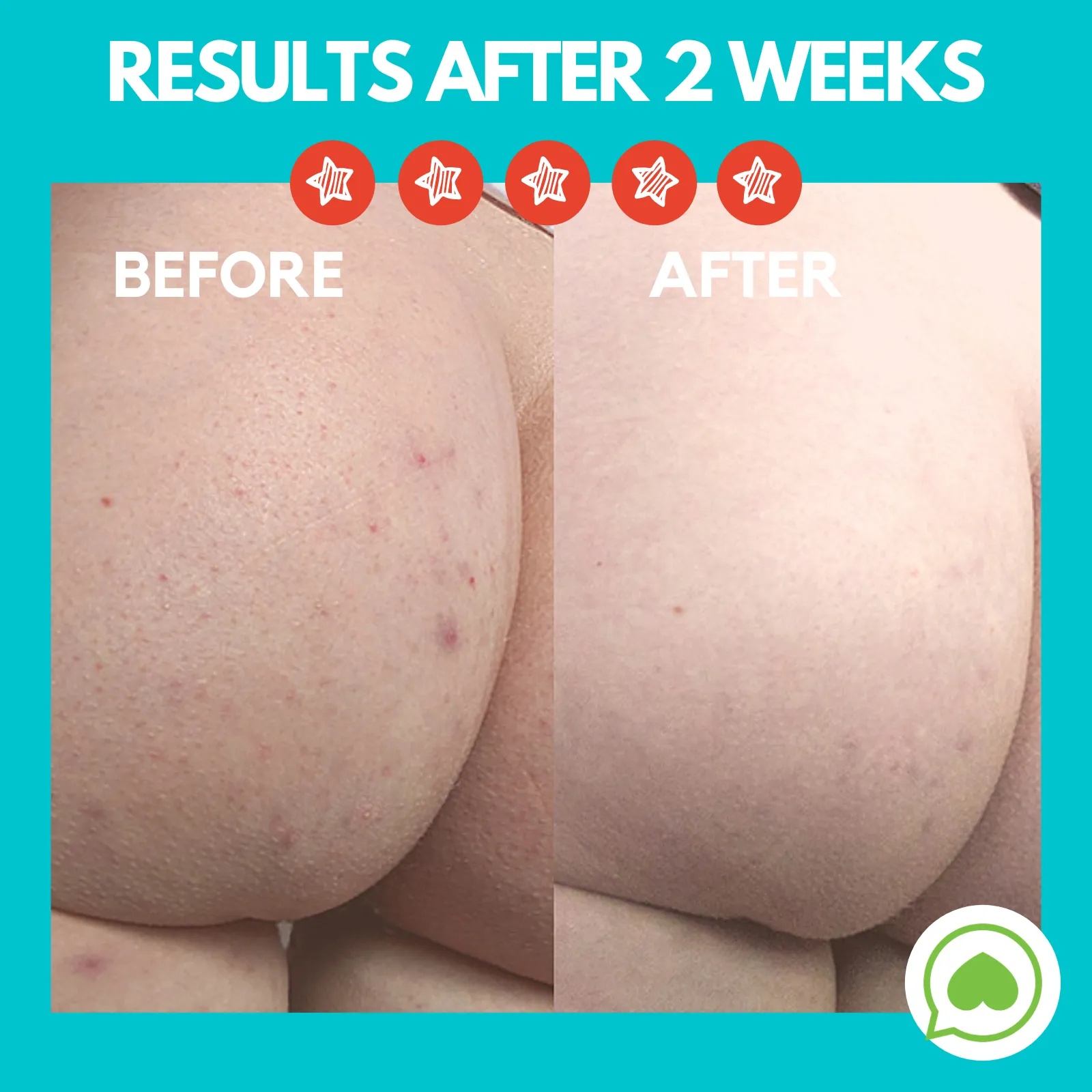 Butt Acne Clearing Lotion ® | 4 oz (113 gr)